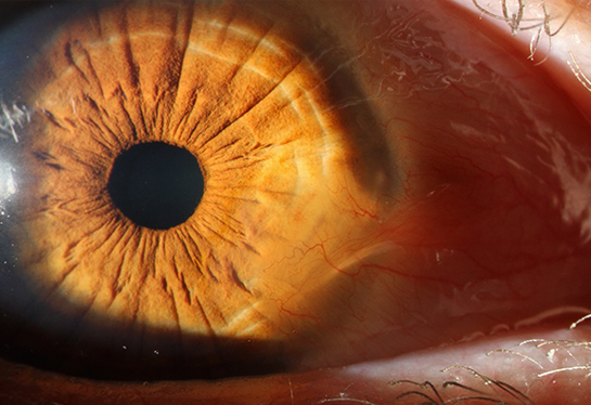 Slit Lamp Imaging