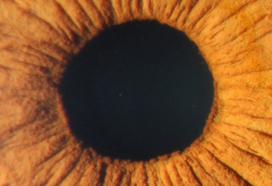 Slit Lamp Imaging