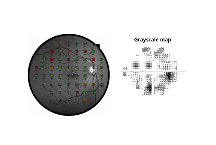 Fundus Automated Perimetry
