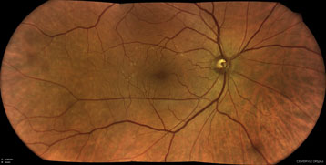 CENTERVUE DRSplus Eye scan test result
