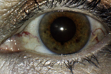 Patient Eye