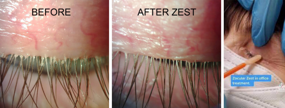 Before and after Zocular treatment